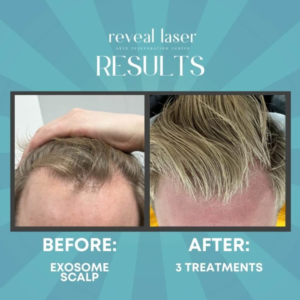 Exosome Therapy for Hair Loss in Islamabad