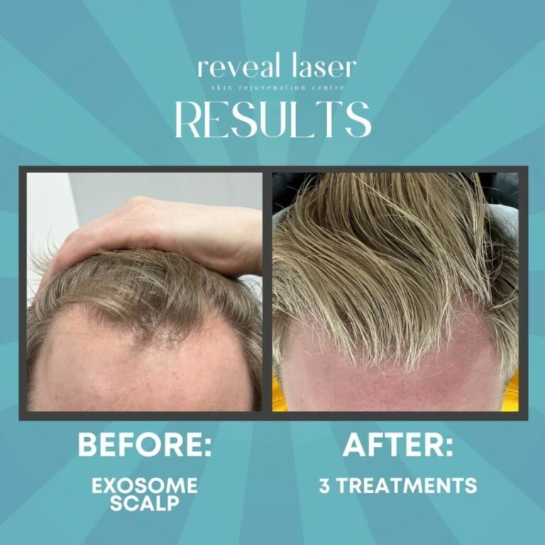 Exosome Therapy for Hair Loss in Islamabad