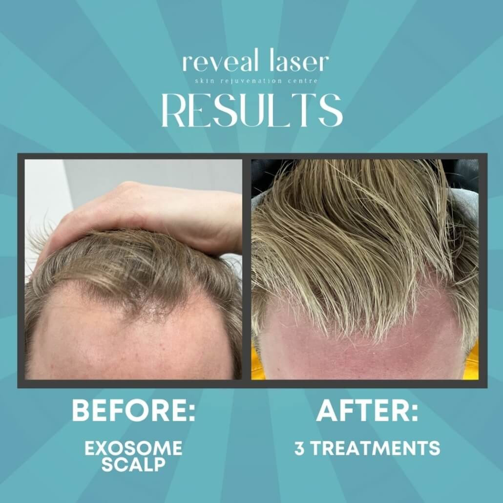 Exosome Therapy for Hair Loss in Islamabad